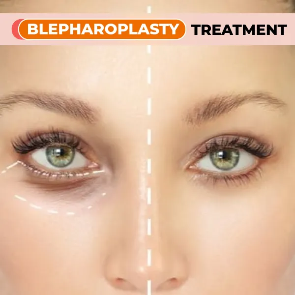 blepharoplasty