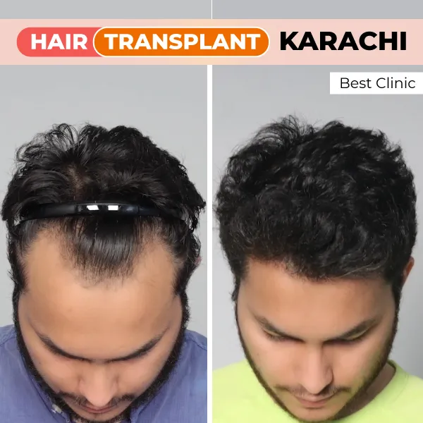 hair transplant in karachi