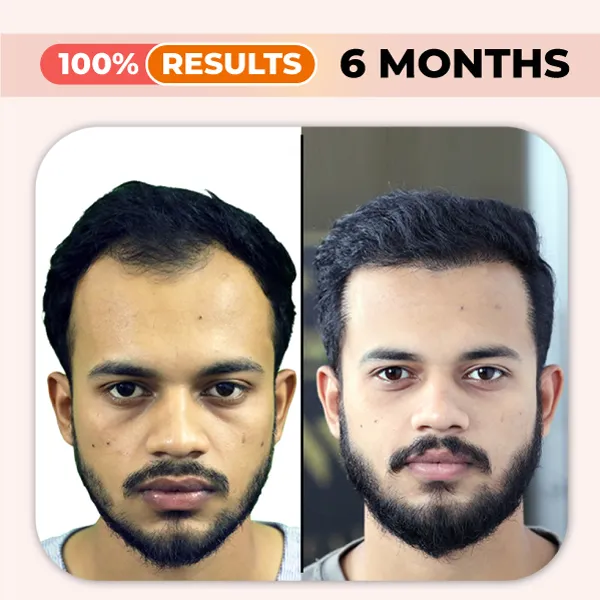 best hair transplant in karachi