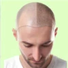 hair transplant