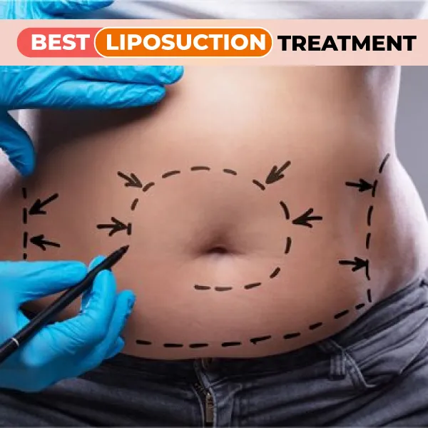 liposuction