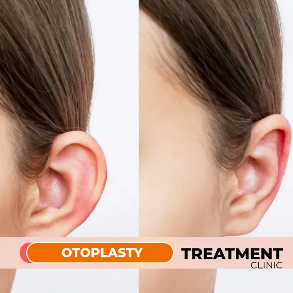 otoplasty