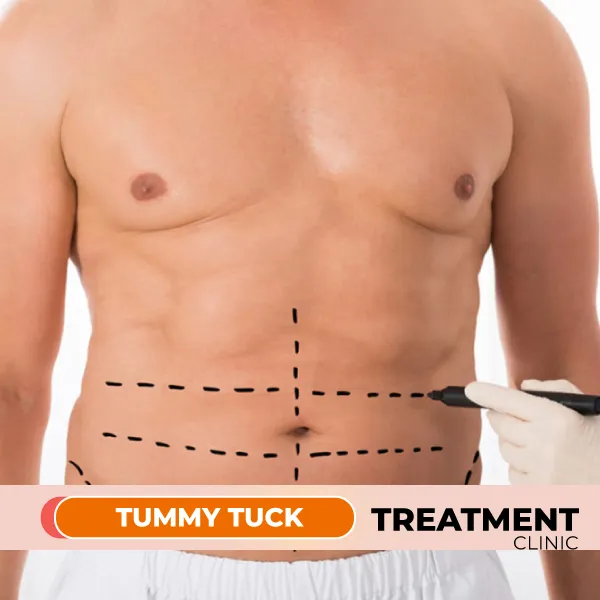 Tummy Tuck