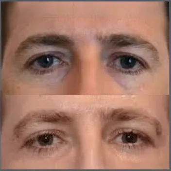 blepharoplasty before after