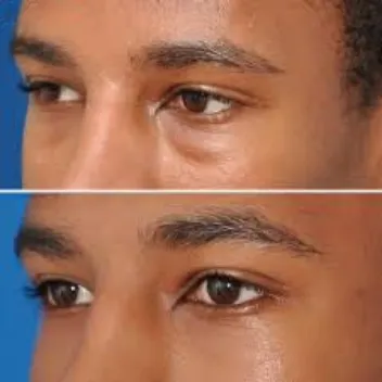 blepharoplasty before after