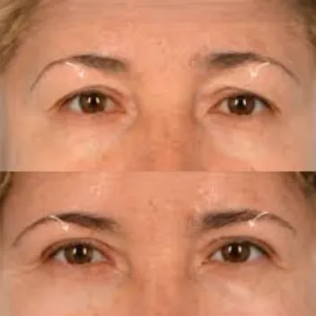 eyelid surgery before after