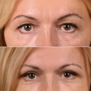 eyelid surgery blepharoplasty