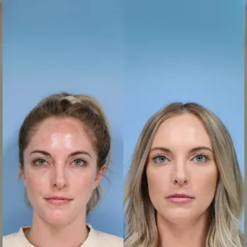 dermal fillers