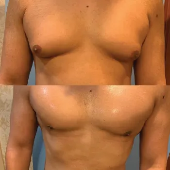 gynecomastia before after