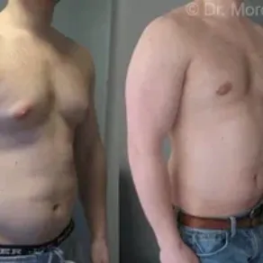 gynecomastia before after