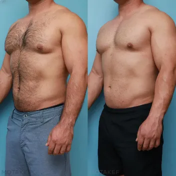 gynecomastia man boobs