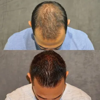 hair transplant before after