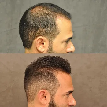 hair transplant before after