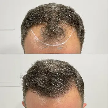 hair transplant before after