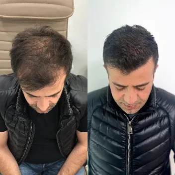 hair transplant karachi before after