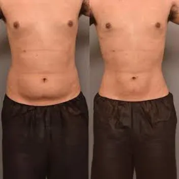 liposuction before after