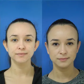 otoplasty before after