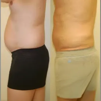 slimming drips before after