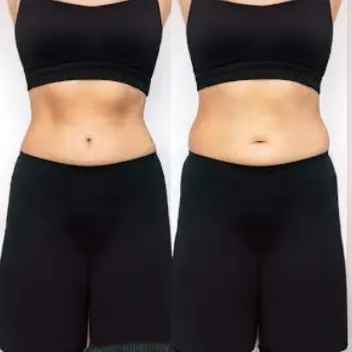 tummy tuck before after