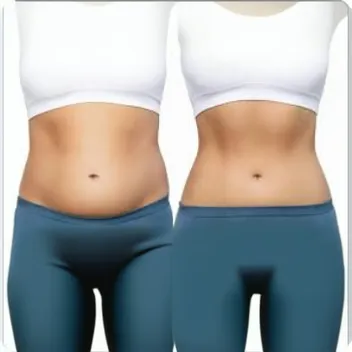 tummy tuck