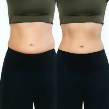 tummy tuck before after