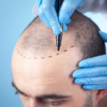 hair transplant