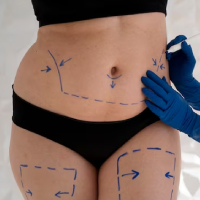 liposuction treatment