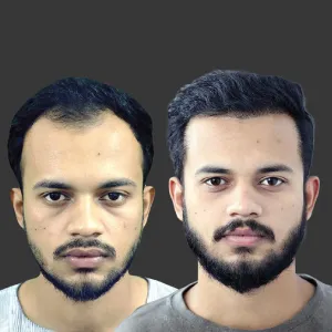 hair transplant