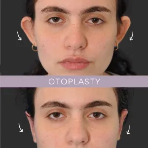 otoplasty