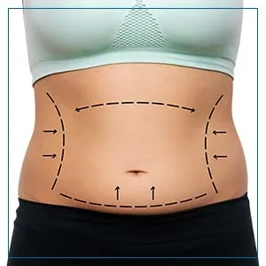 tummy tuck treatment