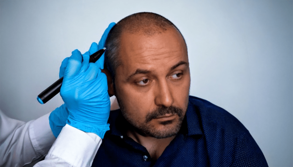 Hair Transplant: Can it Save a Bald Scalp?