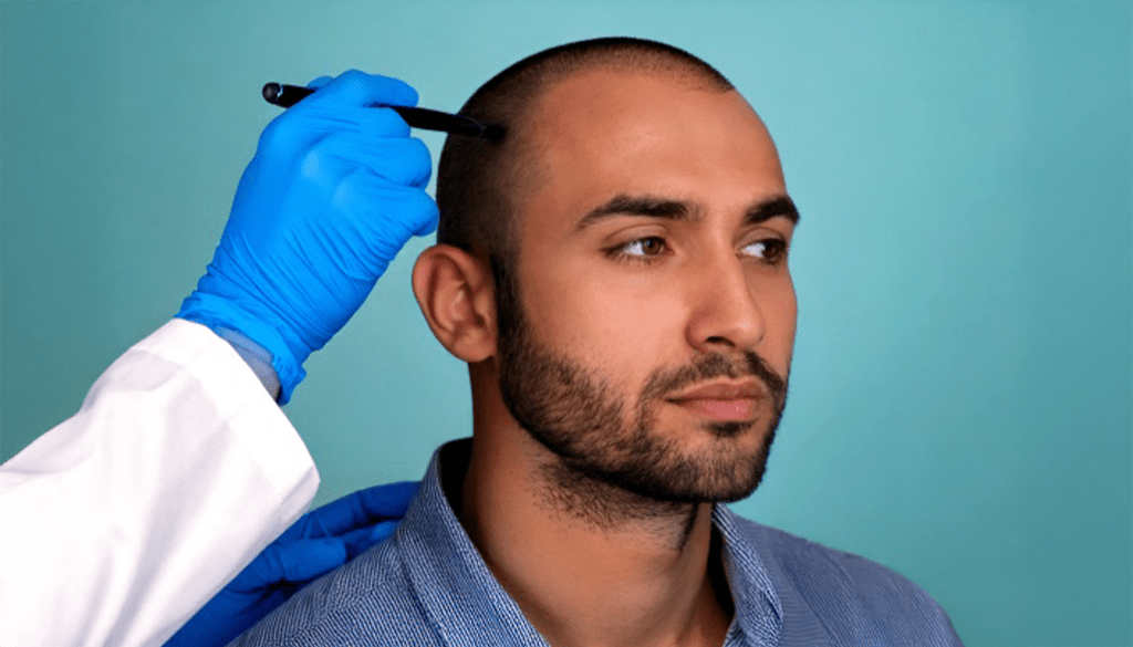 Is Hair Transplant in Karachi Worth It? Here’s the Truth