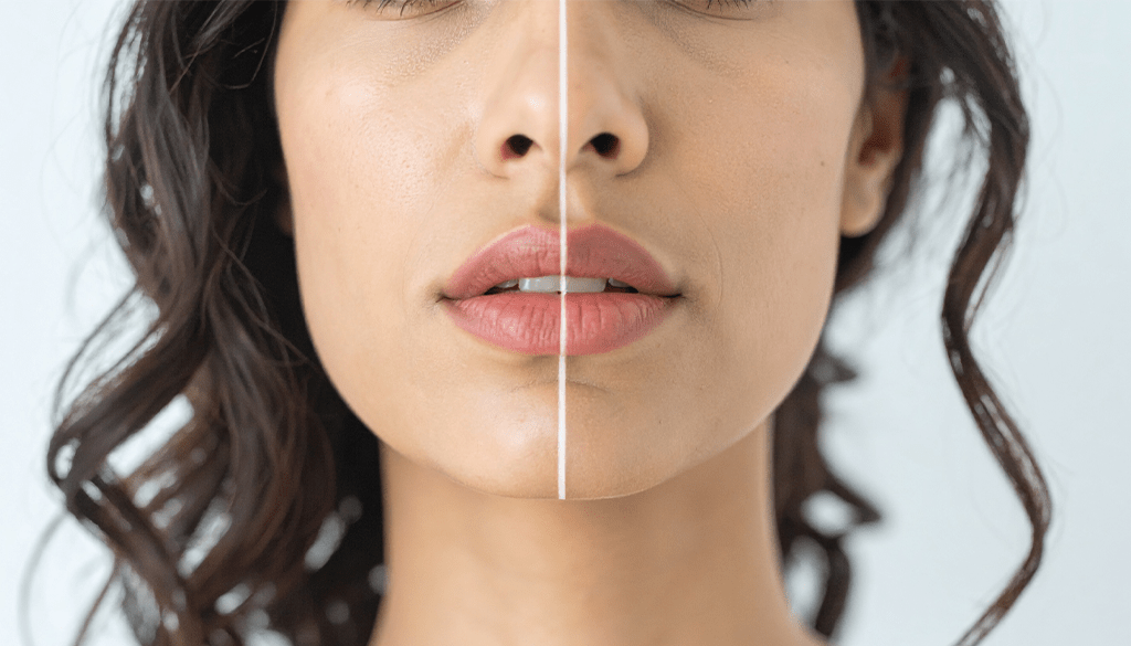 Lip Fillers for Plumper Lips: Yay or Nay?